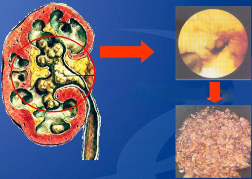 经皮肾镜取石术