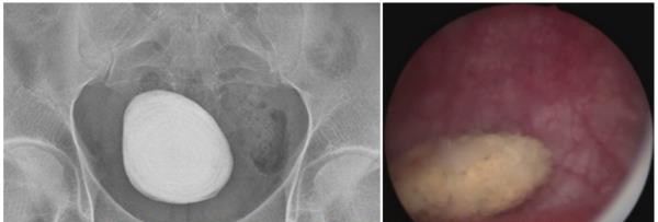 经尿道膀胱结石钬激光碎石术