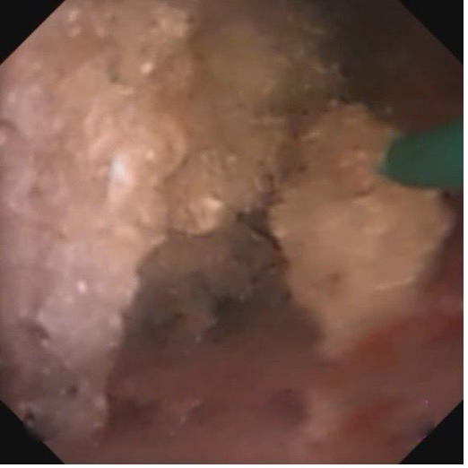 经尿道肾输尿管结石输尿管软镜下激光碎石术（负压吸引）