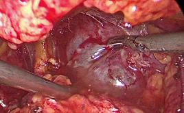 腹腔镜肾囊肿去顶术