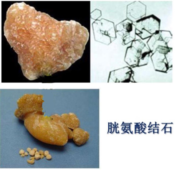 结石成分分析