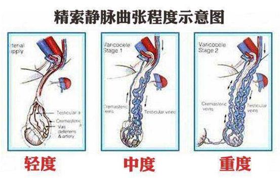 精索内静脉高位结扎术（包括腹腔镜）