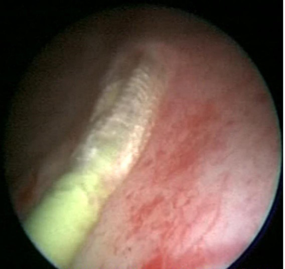 经尿道输尿管狭窄高压球囊扩张术