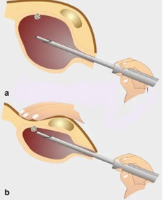 经尿道膀胱肿瘤电切术