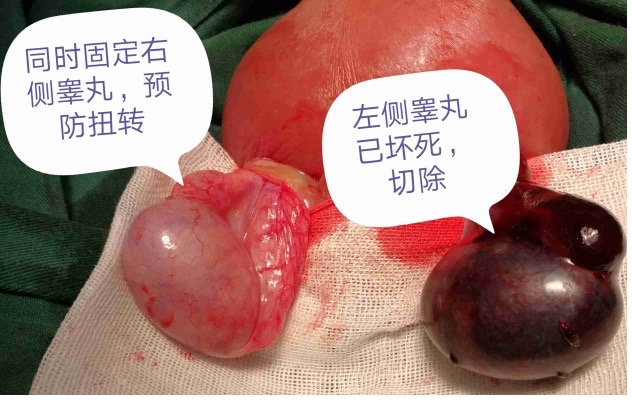 睾丸扭转探查复位固定术（急诊）