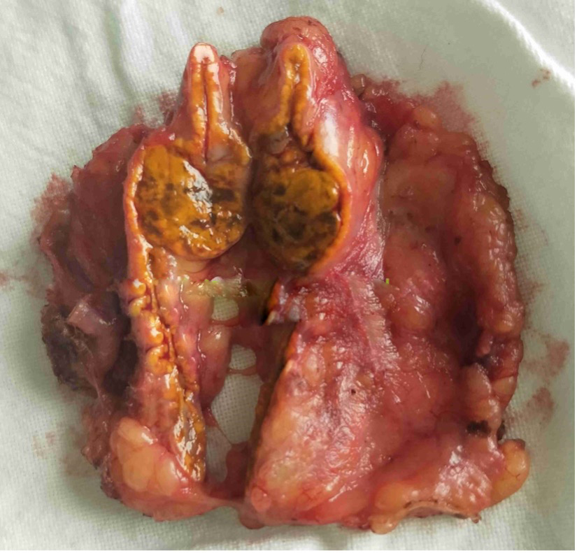 腹腔镜肾上腺肿物切除术