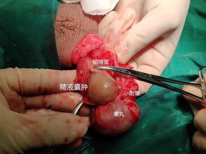 睾丸或附睾肿物切除术