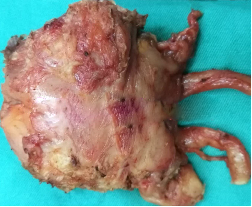 腹腔镜前列腺癌根治术