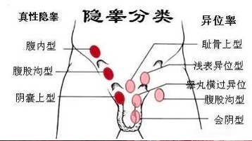 隐睾探查及下降固定术（包括腹腔镜）
