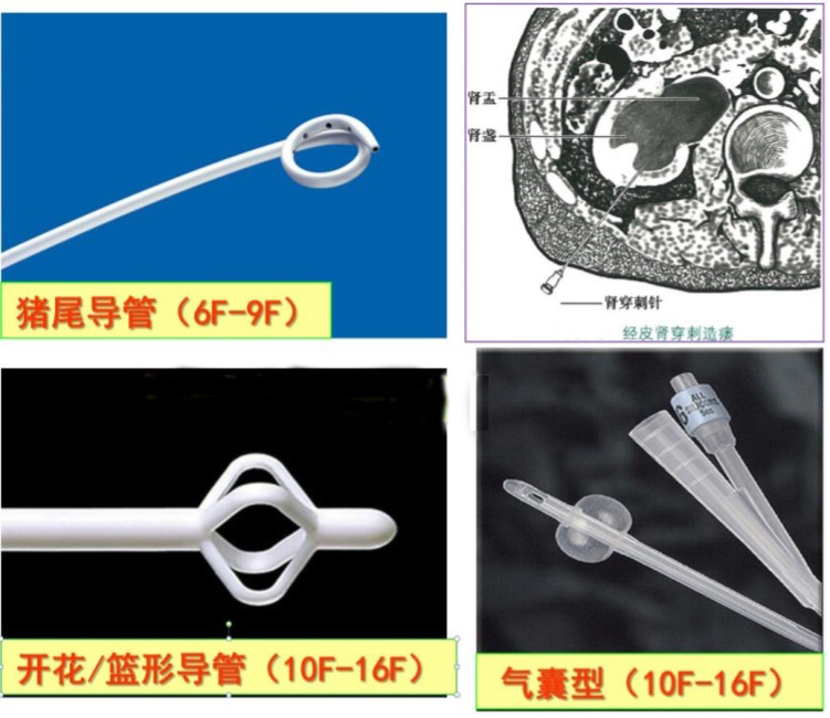 超声引导下经皮肾穿刺造瘘术