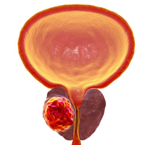 腹腔镜前列腺癌根治术