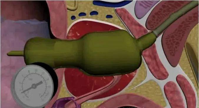 经尿道超微创前列腺柱状水囊扩开术