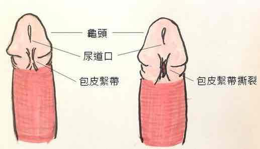 包皮系带修复术（系带撕裂、系带过短、系带畸形）
