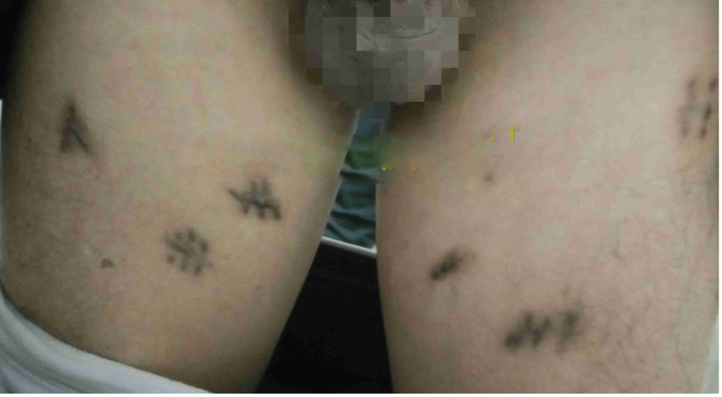 腹腔镜腹股沟/盆腔淋巴结清扫术