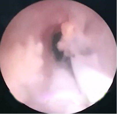 输尿管（硬/软）镜上尿路黏膜肿物激光切除术