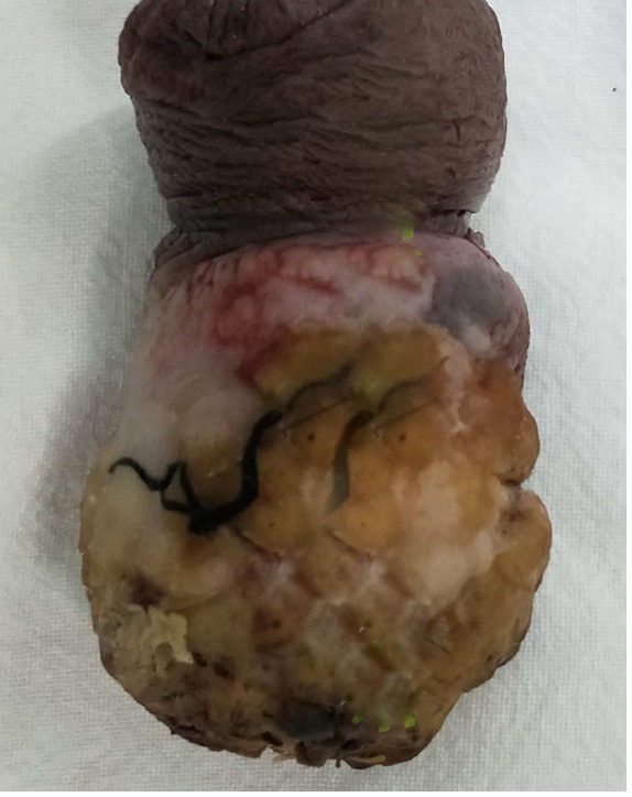 阴茎部分切除或全切除术