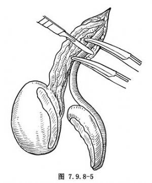 睾丸或附睾肿物切除术