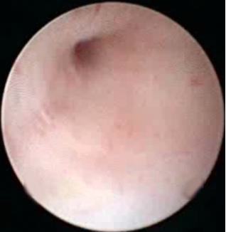 经尿道输尿管狭窄高压球囊扩张术