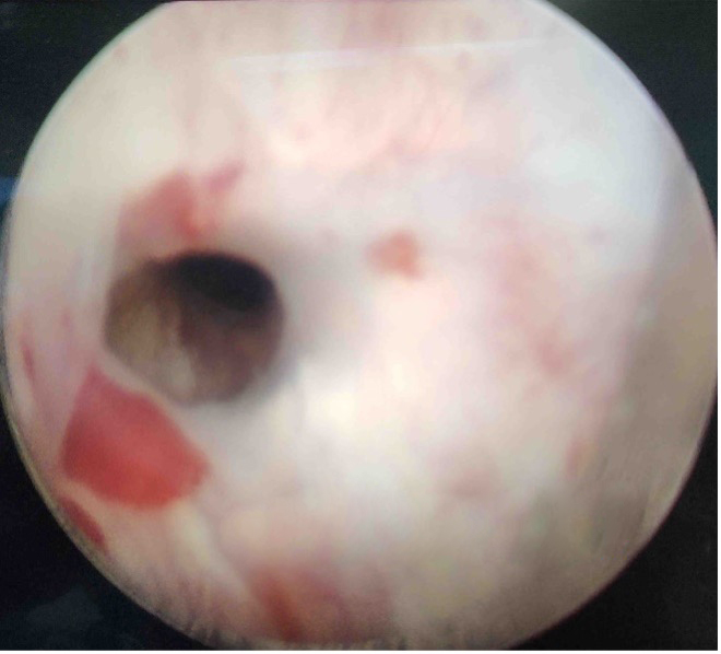 经尿道尿道狭窄冷刀/激光内切开术