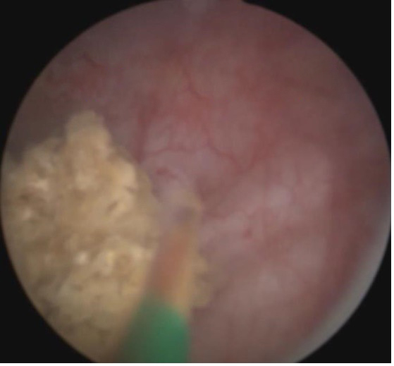 经尿道膀胱结石钬激光碎石术