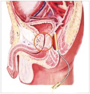 前列腺场效治疗