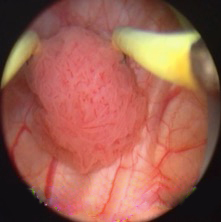 经尿道膀胱肿瘤电切术