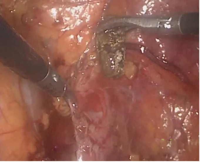 腹腔镜输尿管切开取石术