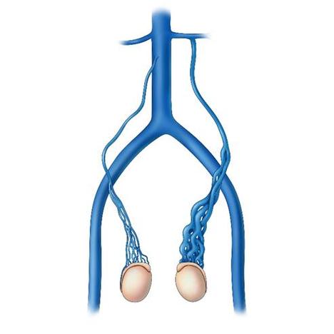 精索内静脉高位结扎术（包括腹腔镜）