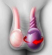 睾丸扭转探查复位固定术（急诊）