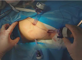 腹腔镜腹股沟/盆腔淋巴结清扫术