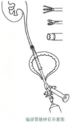 经尿道输尿管结石输尿管硬镜下激光碎石术