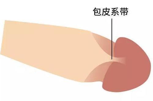 包皮系带修复术（系带撕裂、系带过短、系带畸形）