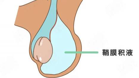 睾丸鞘膜翻转术