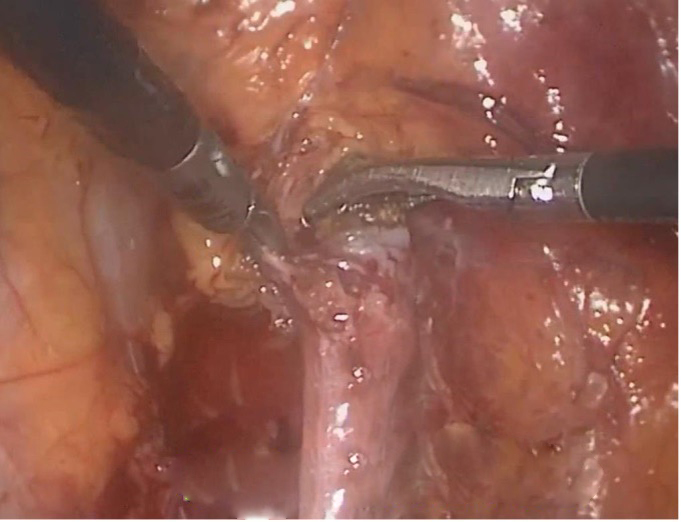 腹腔镜输尿管切开取石术