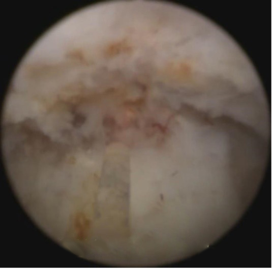 经尿道前列腺剜除术