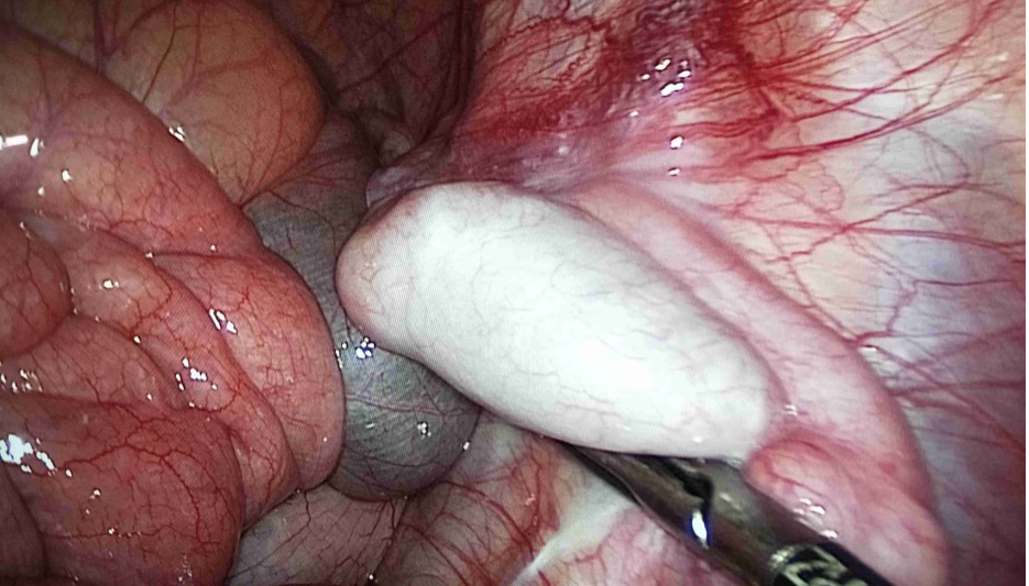 隐睾探查及下降固定术（包括腹腔镜）