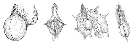 睾丸鞘膜翻转术