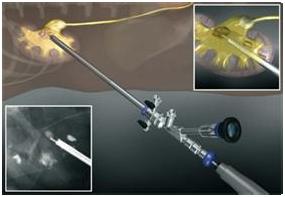 经皮肾镜取石术