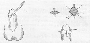 包皮系带修复术（系带撕裂、系带过短、系带畸形）