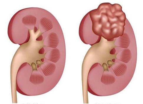 腹腔镜肾癌根治性切除术
