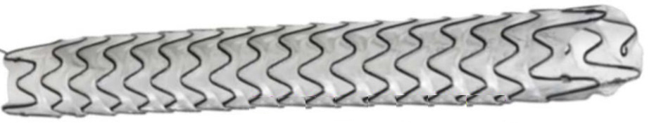 经尿道输尿管狭窄以色列Allium覆膜支架置入术