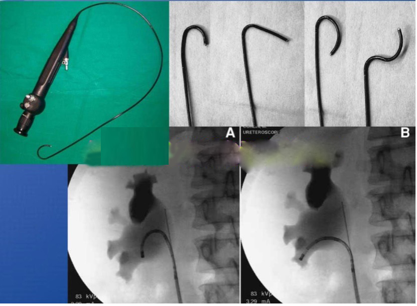 经尿道肾输尿管结石输尿管软镜下激光碎石术（负压吸引）