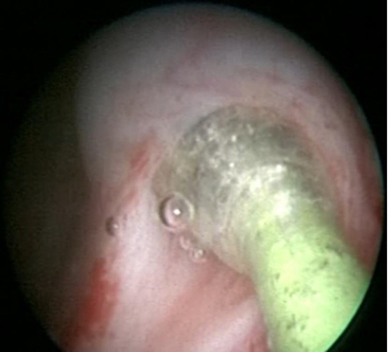 经尿道输尿管狭窄高压球囊扩张术