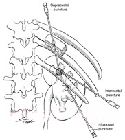 经皮肾镜取石术