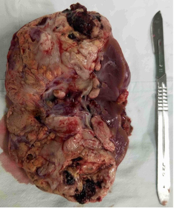 腹腔镜肾癌根治性切除术