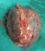 腹腔镜保留肾单位的肾肿瘤切除术