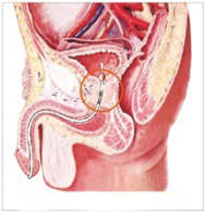 前列腺场效治疗