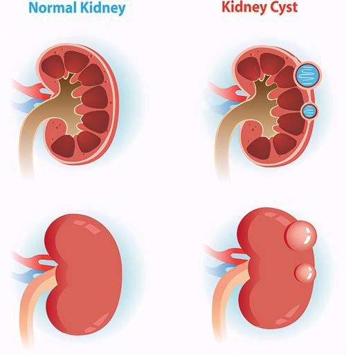 腹腔镜肾囊肿去顶术