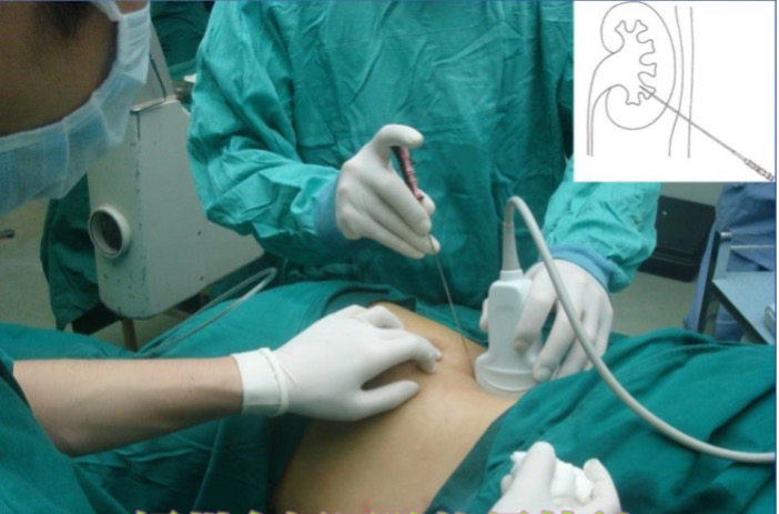 超声引导下经皮肾穿刺造瘘术