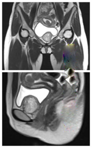 腹腔镜盆腔肿物切除术